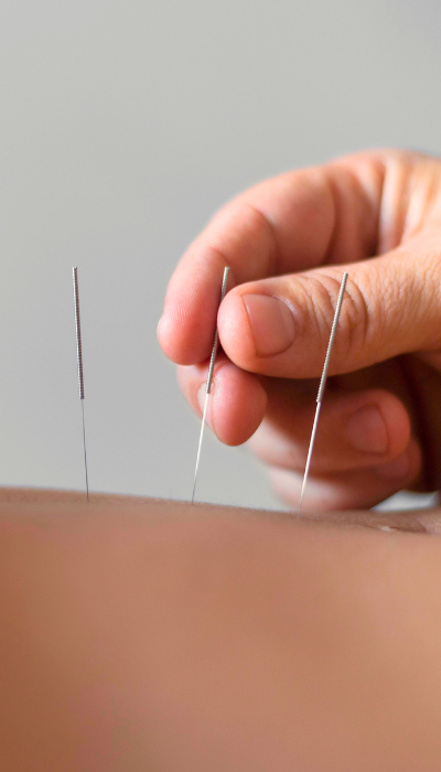 acupuncture-10